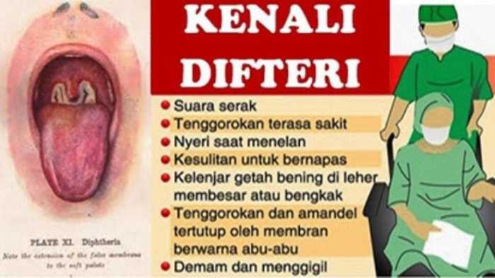 15 Orang Terindikasi, 3 Positif Difteri di Bojonegoro