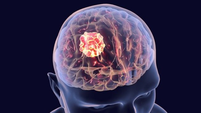 Hari Kanker Sedunia, Wajib Tahu Perbedaan Antara Kanker dan Tumor