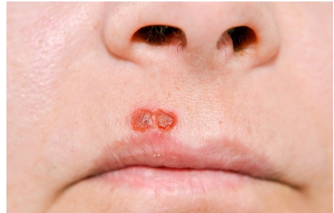 Mengenal Herpes, dan Tipe-tipenya
