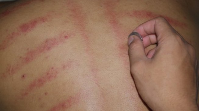 Jangan Kerokan Setiap Hari, Dokter Ungkap Dampaknya Ngeri Banget