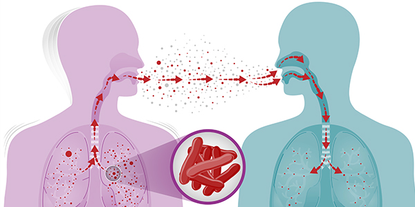 Dalam 3 Bulan Dinkes Bojonegoro Catat 282 Pasien Tuberkulosis