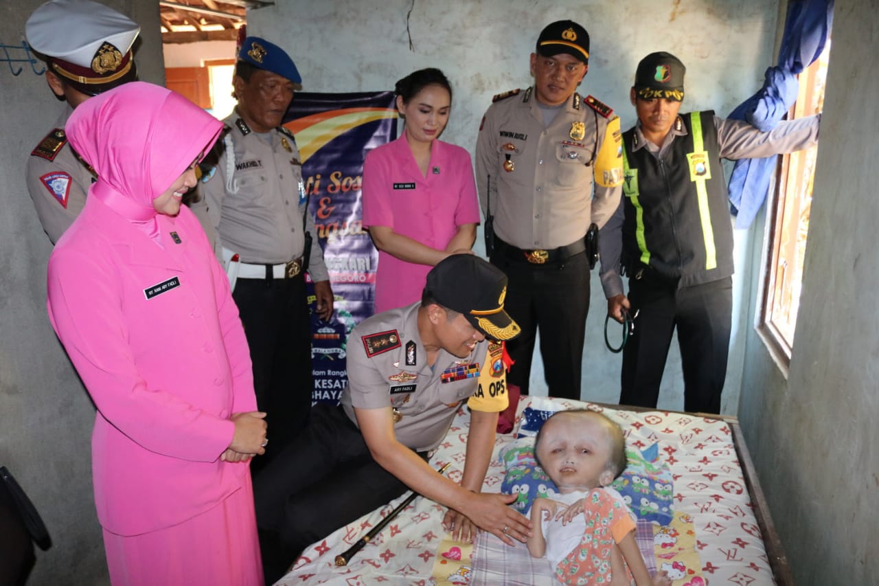 Memprihatinkan, Anak 14 Tahun di Trucuk Derita Hidrosefalus