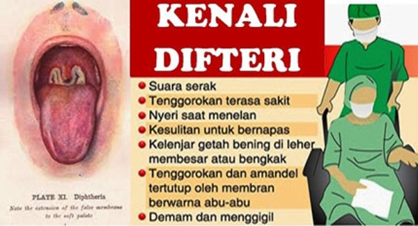 Ada 4 Kasus Awal 2018, Bojonegoro Belum Masuk KLB Difteri